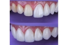 Покрытие винирами 8 зубов