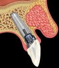 Имплантация костного материала