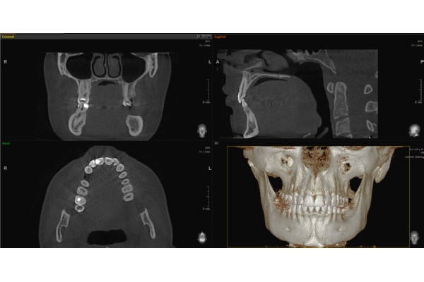 Конусно-лучевая компьютерная томография зубов